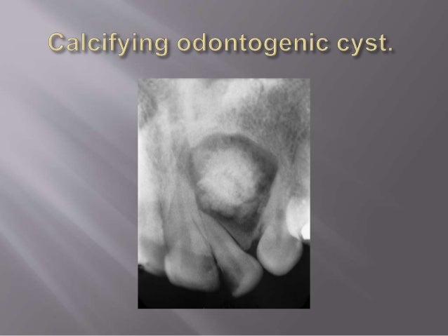 odontogenic cysts odontogenic cyst