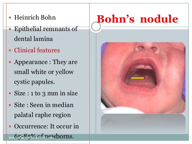 gingival curettage