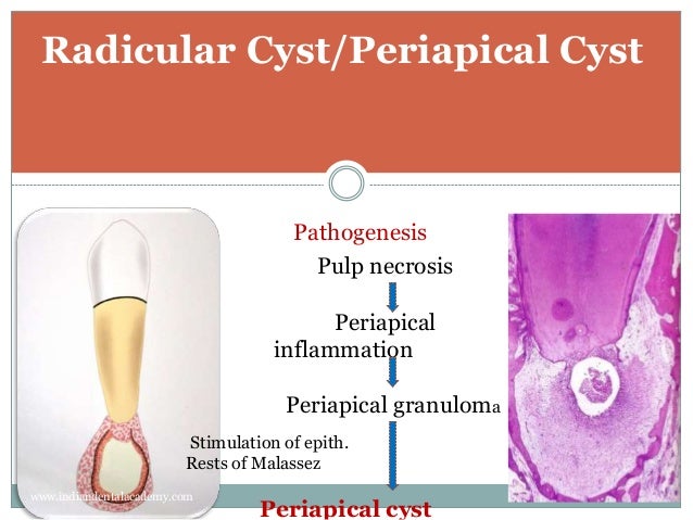dental cyst