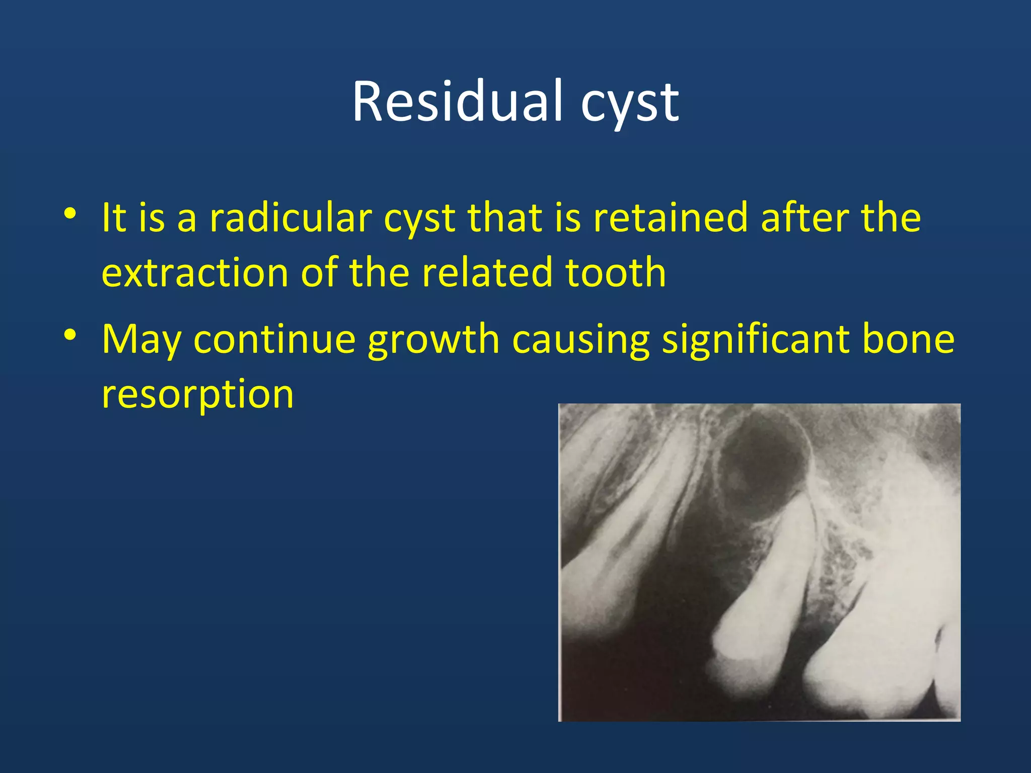 Residual cyst
• It is a radicular cyst that is retained after the
extraction of the related tooth
• May continue growth causing significant bone
resorption
 