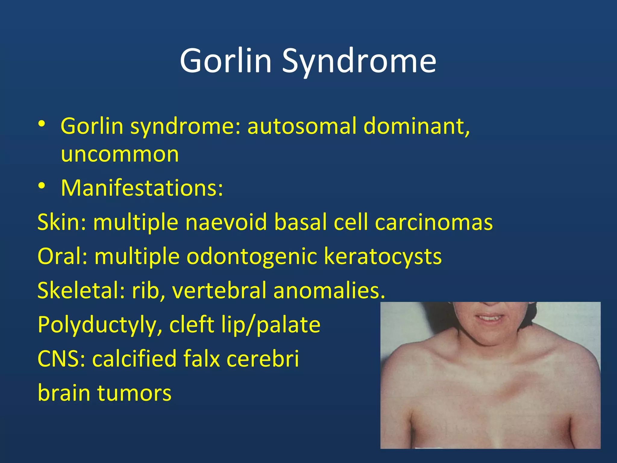 Gorlin Syndrome
• Gorlin syndrome: autosomal dominant,
uncommon
• Manifestations:
Skin: multiple naevoid basal cell carcinomas
Oral: multiple odontogenic keratocysts
Skeletal: rib, vertebral anomalies.
Polyductyly, cleft lip/palate
CNS: calcified falx cerebri
brain tumors
 