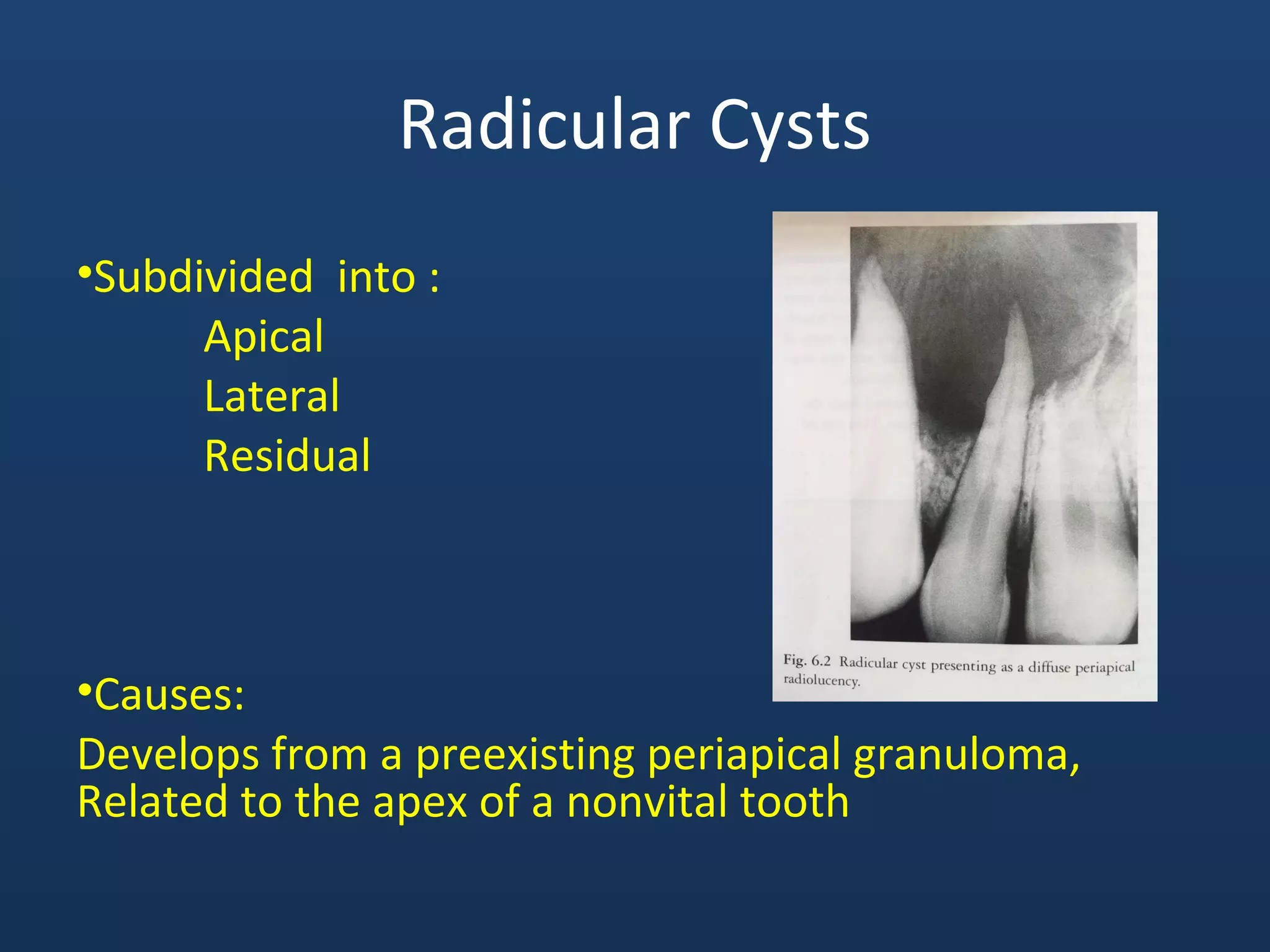 Radicular Cysts
•Subdivided into :
Apical
Lateral
Residual
•Causes:
Develops from a preexisting periapical granuloma,
Related to the apex of a nonvital tooth
 