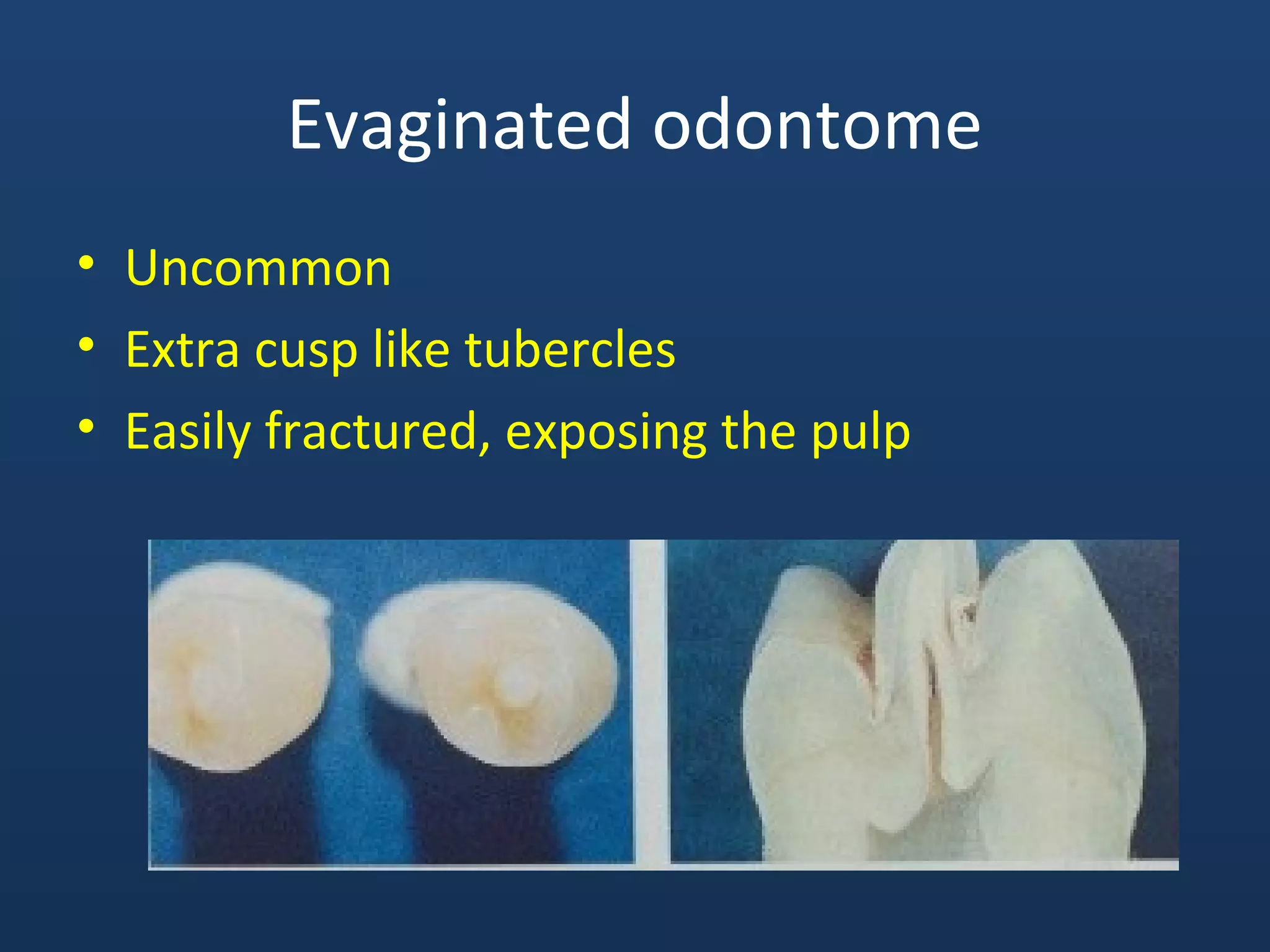 Evaginated odontome
• Uncommon
• Extra cusp like tubercles
• Easily fractured, exposing the pulp
 
