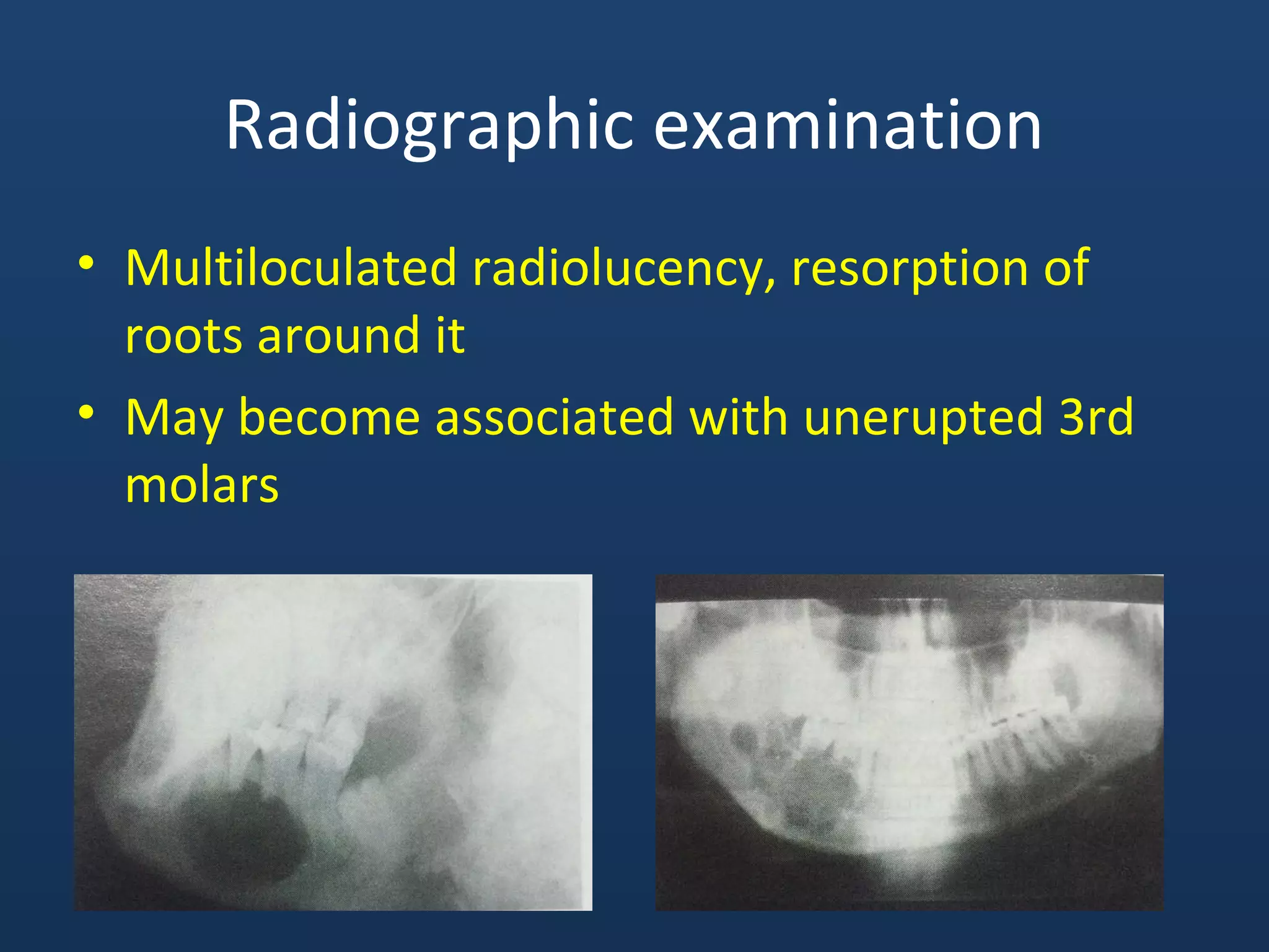 Radiographic examination
• Multiloculated radiolucency, resorption of
roots around it
• May become associated with unerupted 3rd
molars
 