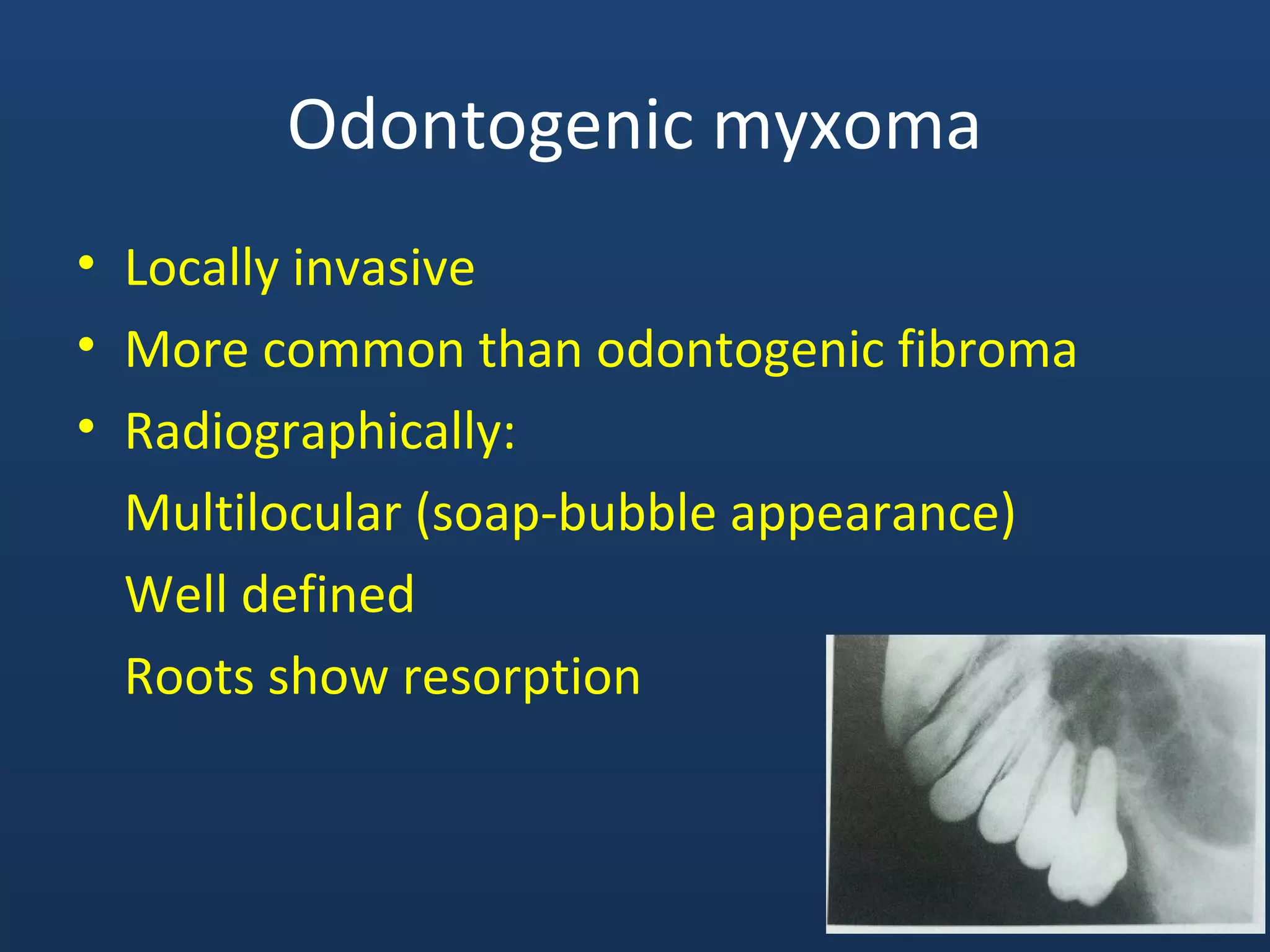 Odontogenic myxoma
• Locally invasive
• More common than odontogenic fibroma
• Radiographically:
Multilocular (soap-bubble appearance)
Well defined
Roots show resorption
 