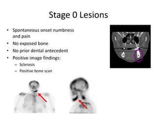 Stage 0 Lesions
• Spontaneous onset numbness
  and pain
• No exposed bone
• No prior dental antecedent
• Positive image findings:
   – Sclerosis
   – Positive bone scan




                          ikassem@dr.com
 