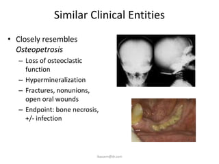 Similar Clinical Entities
• Closely resembles
  Osteopetrosis
  – Loss of osteoclastic
    function
  – Hypermineralization
  – Fractures, nonunions,
    open oral wounds
  – Endpoint: bone necrosis,
    +/- infection




                           ikassem@dr.com
 