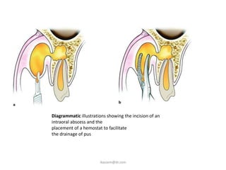 Diagrammatic illustrations showing the incision of an
intraoral abscess and the
placement of a hemostat to facilitate
the drainage of pus




                       ikassem@dr.com
 