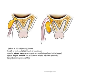 Spread of pus depending on the
length of root and attachment of buccinator
muscle. a Apex above attachment: accumulation of pus in the buccal
space. b Apex beneath the buccinator muscle intraoral pathway
towards the mucobuccal fold




                                             ikassem@dr.com
 