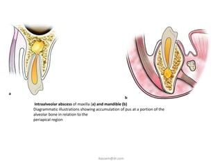 Intraalveolar abscess of maxilla (a) and mandible (b)
Diagrammatic illustrations showing accumulation of pus at a portion of the
alveolar bone in relation to the
periapical region




                                    ikassem@dr.com
 