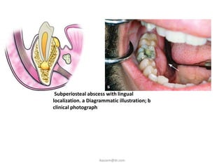 Subperiosteal abscess with lingual
localization. a Diagrammatic illustration; b
clinical photograph




                    ikassem@dr.com
 