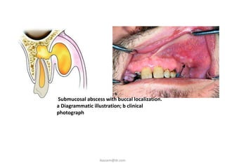Submucosal abscess with buccal localization.
a Diagrammatic illustration; b clinical
photograph




                 ikassem@dr.com
 