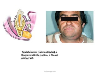Fascial abscess (submandibular). a
Diagrammatic illustration. b Clinical
photograph




                       ikassem@dr.com
 
