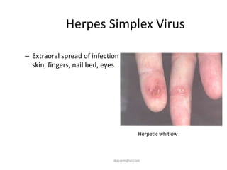Herpes Simplex Virus

– Extraoral spread of infection:
  skin, fingers, nail bed, eyes




                                          Herpetic whitlow



                             ikassem@dr.com
 