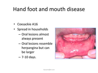 Hand foot and mouth disease

• Coxsackie A16
• Spread in households
   – Oral lesions almost
     always present
   – Oral lesions resemble
     herpangina but can
     be larger
   – 7-10 days.


                   ikassem@dr.com
 