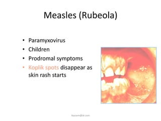 Measles (Rubeola)

•   Paramyxovirus
•   Children
•   Prodromal symptoms
•   Koplik spots disappear as
    skin rash starts




                    ikassem@dr.com
 