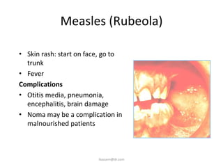 Measles (Rubeola)

• Skin rash: start on face, go to
  trunk
• Fever
Complications
• Otitis media, pneumonia,
  encephalitis, brain damage
• Noma may be a complication in
  malnourished patients



                         ikassem@dr.com
 