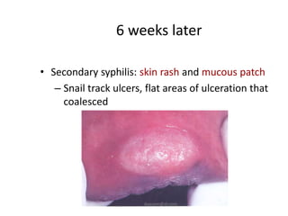 6 weeks later

• Secondary syphilis: skin rash and mucous patch
   – Snail track ulcers, flat areas of ulceration that
     coalesced




                        ikassem@dr.com
 