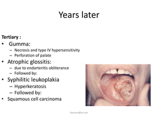 Years later

Tertiary :
• Gumma:
    – Necrosis and type IV hypersensitivity
    – Perforation of palate
• Atrophic glossitis:
    – due to endarteritis obliterance
    – Followed by:
• Syphilitic leukoplakia
   – Hyperkeratosis
   – Followed by:
• Squamous cell carcinoma

                                        ikassem@dr.com
 