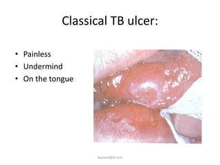 Classical TB ulcer:

• Painless
• Undermind
• On the tongue




                   ikassem@dr.com
 