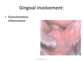 Gingival involvement:
• Granulomatous
  inflammation




                  ikassem@dr.com
 