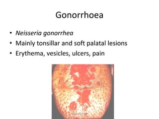 Gonorrhoea
• Neisseria gonorrhea
• Mainly tonsillar and soft palatal lesions
• Erythema, vesicles, ulcers, pain




                      ikassem@dr.com
 