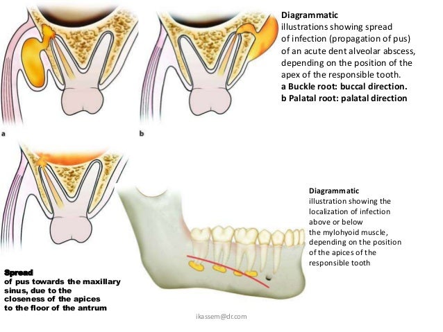 Abcessed tooth brain infection