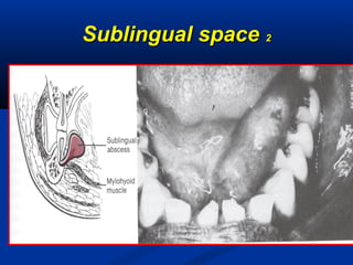 Sublingual spaceSublingual space 22
 