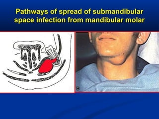 Pathways of spread of submandibularPathways of spread of submandibular
space infection from mandibular molarspace infection from mandibular molar
 