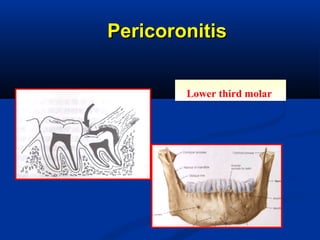 PericoronitisPericoronitis
Lower third molarLower third molar
 