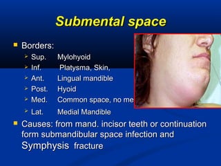 Submental spaceSubmental space
 Borders:Borders:
 Sup.Sup. MylohyoidMylohyoid
 Inf.Inf. Platysma, Skin,Platysma, Skin,
 Ant.Ant. Lingual mandibleLingual mandible
 Post.Post. HyoidHyoid
 Med.Med. Common space, no medial wallCommon space, no medial wall
 Lat.Lat. Medial MandibleMedial Mandible
 Causes: from mand. incisor teeth or continuationCauses: from mand. incisor teeth or continuation
form submandibular space infection andform submandibular space infection and
SymphysisSymphysis fracturefracture
 