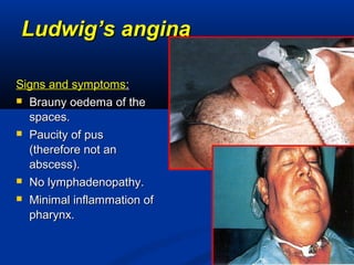 Ludwig’s anginaLudwig’s angina
Signs and symptomsSigns and symptoms::
 Brauny oedema of theBrauny oedema of the
spaces.spaces.
 Paucity of pusPaucity of pus
(therefore not an(therefore not an
abscess).abscess).
 No lymphadenopathy.No lymphadenopathy.
 Minimal inflammation ofMinimal inflammation of
pharynx.pharynx.
 