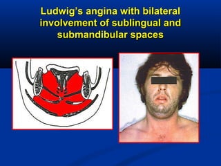 Ludwig’s angina with bilateralLudwig’s angina with bilateral
involvement of sublingual andinvolvement of sublingual and
submandibular spacessubmandibular spaces
 