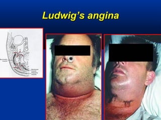 Ludwig’s anginaLudwig’s angina
 