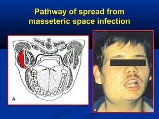 Pathway of spread fromPathway of spread from
masseteric space infectionmasseteric space infection
 