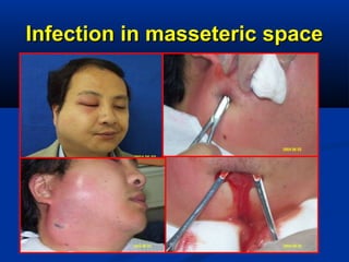 Infection in masseteric spaceInfection in masseteric space
 