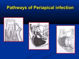 Pathways of Periapical infectionPathways of Periapical infection
 