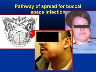 Pathway of spread for buccalPathway of spread for buccal
space infectionspace infection
 