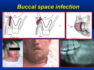 Buccal space infectionBuccal space infection
 