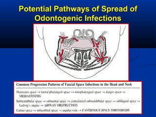 Potential Pathways of Spread ofPotential Pathways of Spread of
Odontogenic InfectionsOdontogenic Infections
 