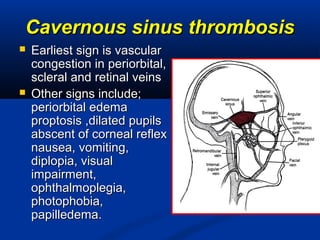 Cavernous sinus thrombosisCavernous sinus thrombosis
 Earliest sign is vascularEarliest sign is vascular
congestion in periorbital,congestion in periorbital,
scleral and retinal veinsscleral and retinal veins
 Other signs include;Other signs include;
periorbital edemaperiorbital edema
proptosis ,dilated pupilsproptosis ,dilated pupils
abscent of corneal reflexabscent of corneal reflex
nausea, vomiting,nausea, vomiting,
diplopia, visualdiplopia, visual
impairment,impairment,
ophthalmoplegia,ophthalmoplegia,
photophobia,photophobia,
papilledema.papilledema.
 