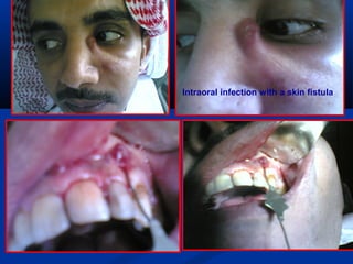 Intraoral infection with a skin fistula
 