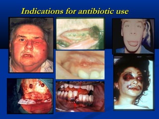Indications for antibiotic useIndications for antibiotic use
 
