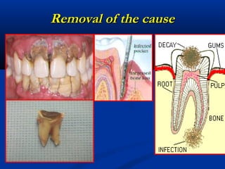 Removal of the causeRemoval of the cause
 