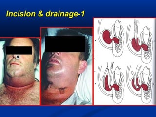 11--Incision & drainageIncision & drainage
 