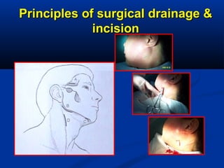 Principles of surgical drainage &Principles of surgical drainage &
incisionincision
 