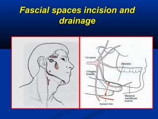 Fascial spaces incision andFascial spaces incision and
drainagedrainage
 