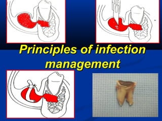 Principles of infectionPrinciples of infection
managementmanagement
 