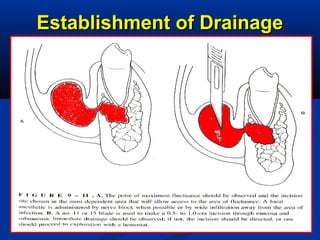Establishment of DrainageEstablishment of Drainage
 