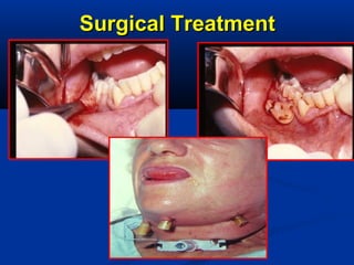 Surgical TreatmentSurgical Treatment
 